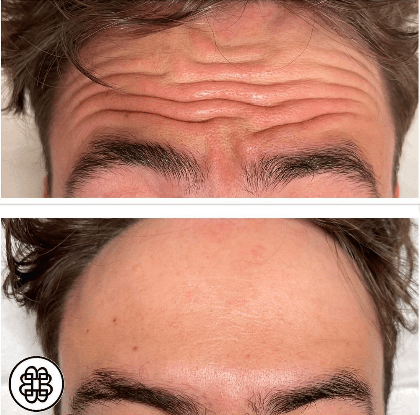 botox 3