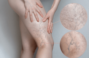 Veins